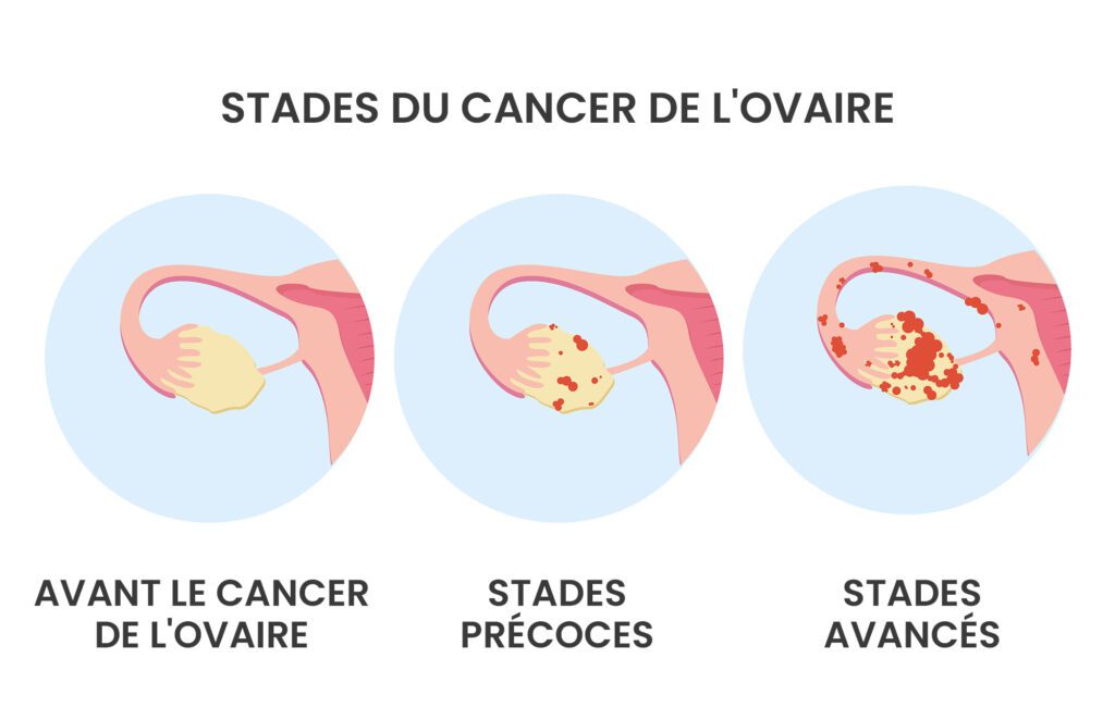 3 stades différents du cancer de l'ovaire, de sain à avancé