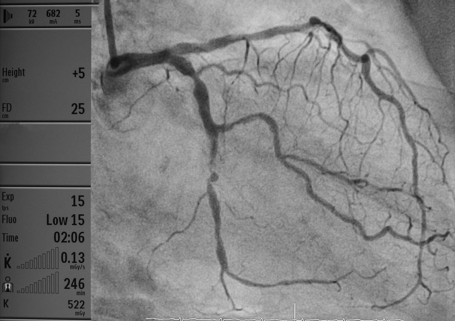 Interventional Radiology, a Less Invasive Approach