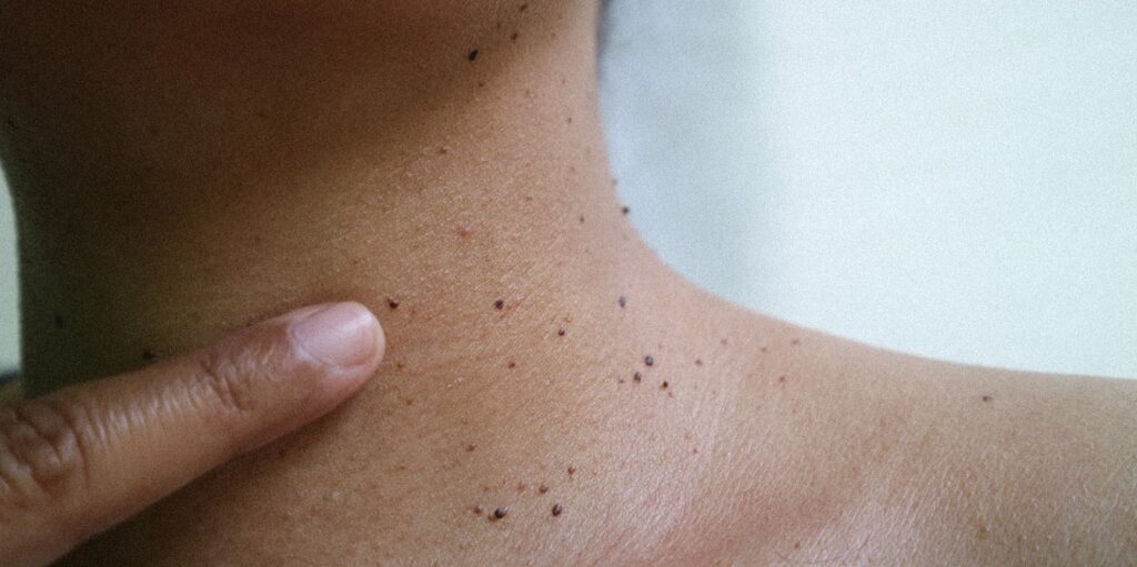 Close up the skin tags on a woman's neck skin.