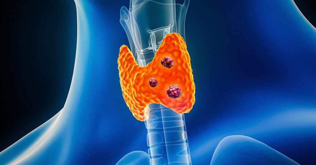 3D render of the thyroid anatomy, showing cancerous thyroid nodules.