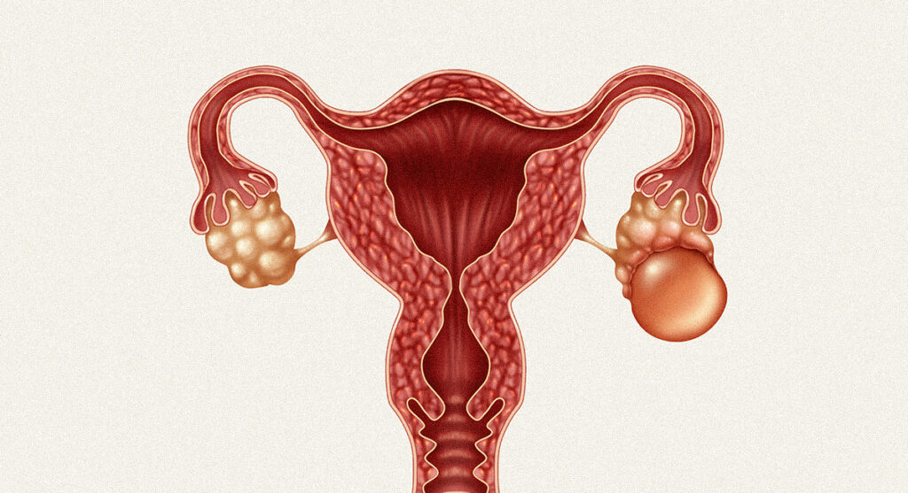 Anatomie utérine montrant des ovaires présentant des kystes.
