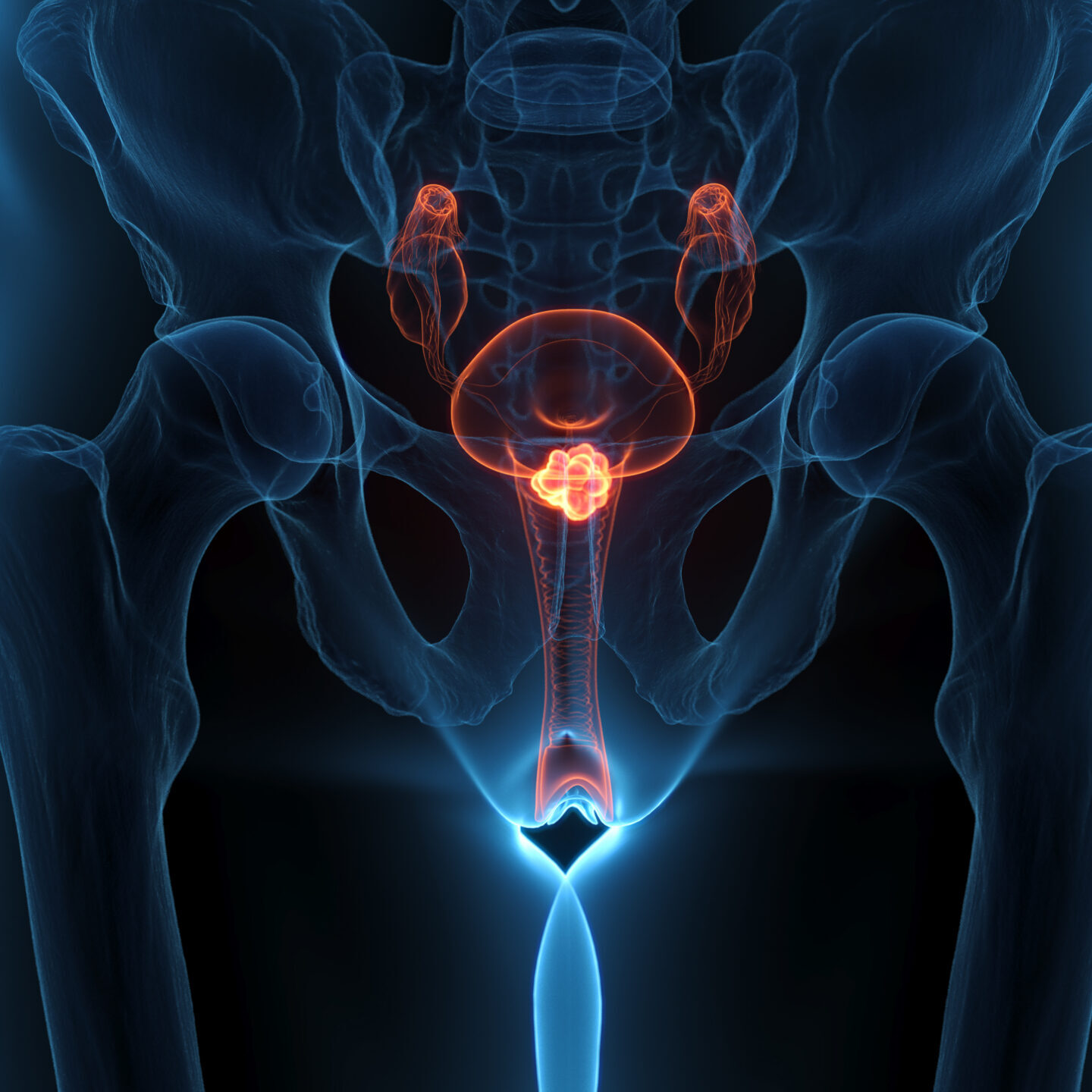 A 3D x-ray render highlights cervical cancer in an adult female, wide angle anterior view, showing tumor mass, semi-transparent against a clean black backdrop.
