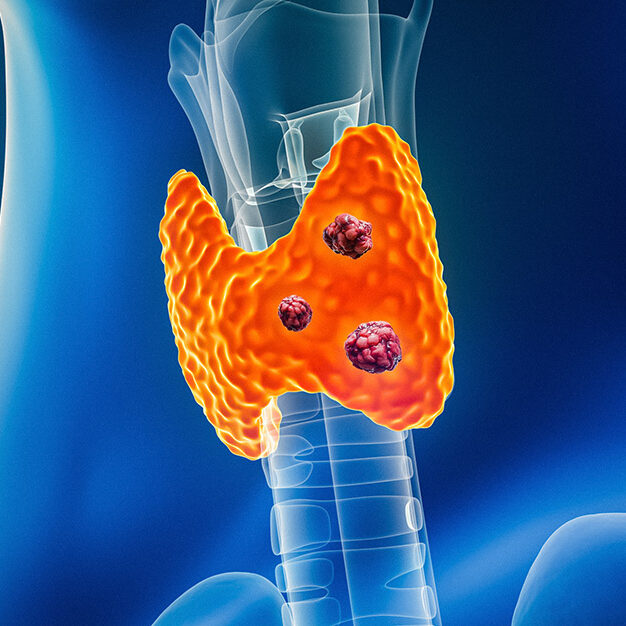 Thyroid cancer with organs and tumors or cancerous cells 3D rendering illustration with male body contours. Anatomy, oncology, biomedical, medical, biology, science, healthcare concepts.