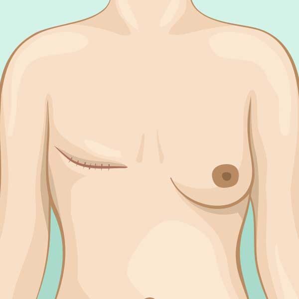 Breast-surgery-masectomy Breast-surgery-masectomy